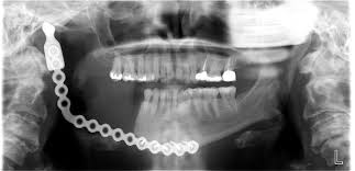 titanium jaw implant.jpg